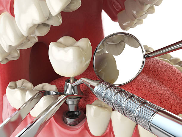 Best Chipped Tooth Repair Near Me  in Pendleton, OR